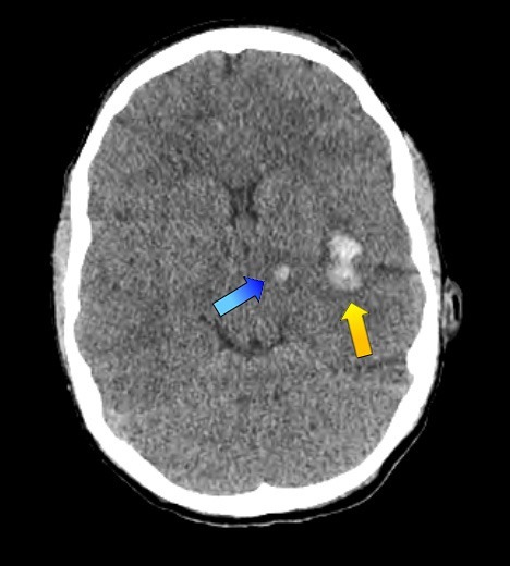 CT brain scan showing left sided bleeding in the thalamus and in the region of the insula.