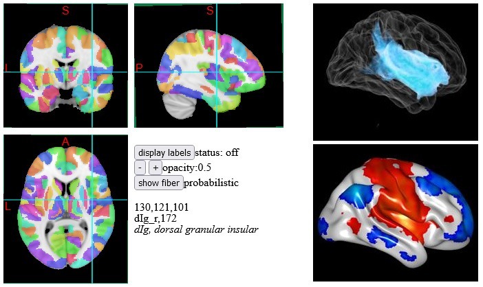 Image showing limited connectivity from the insula bleed.