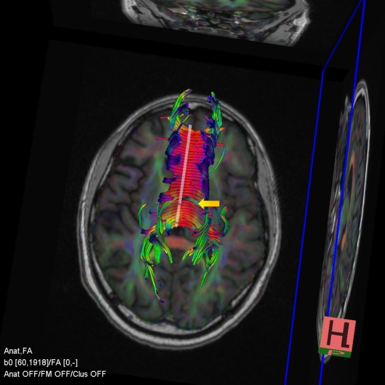 Lesion in the corpus callosum illustrating the use of DTI in functional capacity evaluations