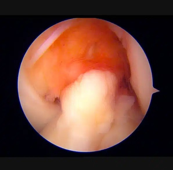 Can a Torn ACL Heal Without Surgery