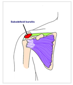 I was having pretty bad neuropathy pain until i got. Subdeltoid Bursitis Natural Treatment | OSMO Patch UK
