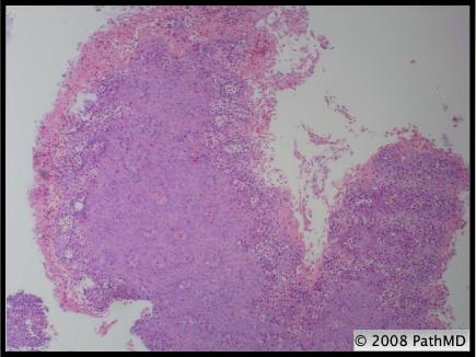 Gastrointestinal Pathology - Part 7, Question #1