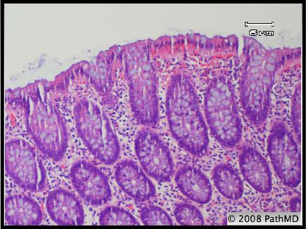 Gastrointestinal Pathology - Part 7, Question #5