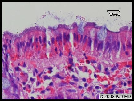 Gastrointestinal Pathology - Part 7, Question #5