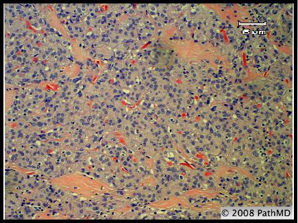 Gastrointestinal Pathology - Part 7, Question #7
