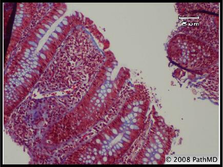 Gastrointestinal Pathology - Part 6, Question #5