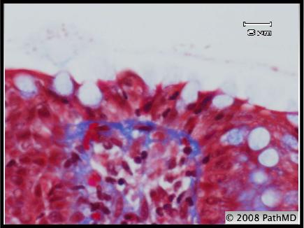 Gastrointestinal Pathology - Part 6, Question #5