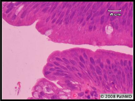 Gastrointestinal Pathology - Part 6, Question #6