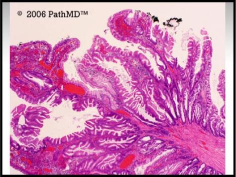 Gastrointestinal Pathology - Set 2, Case #3