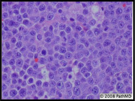 Hematopathology - Part 8, Question #2