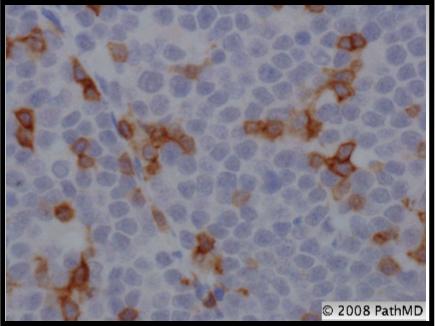 Hematopathology - Part 8, Question #2