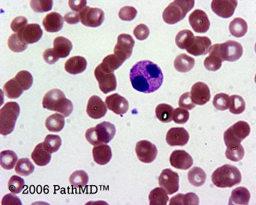 Peripheral Blood Part 1, Case #1