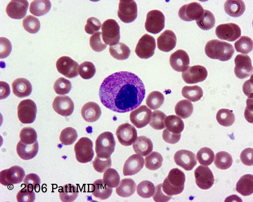 Peripheral Blood Part 1, Case #1