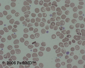 Peripheral Blood Part 1, Case #2