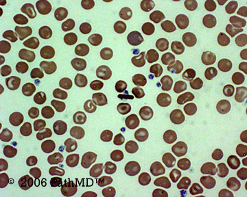 Peripheral Blood Part 1, Case #2