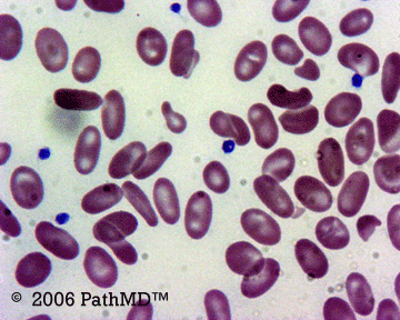 Peripheral Blood Part 1, Case #3
