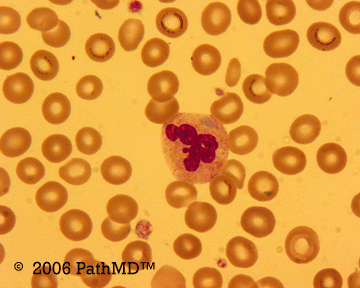 Peripheral Blood Part 1, Case #4