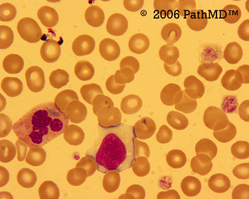 Peripheral Blood Part 1, Case #4