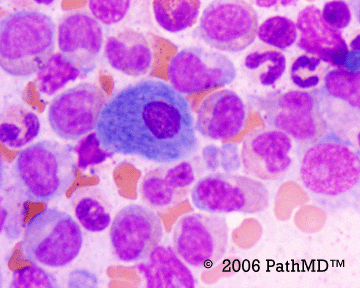 Peripheral Blood Part 1, Case #5