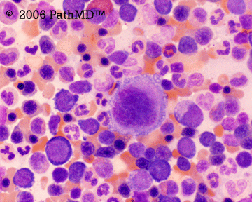 Peripheral Blood Part 1, Case #5