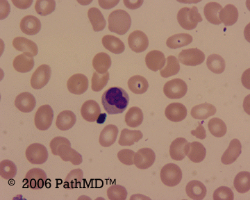Peripheral Blood - Part 1, Case #6