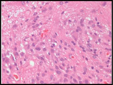 Neuropathology Set 2 Q12