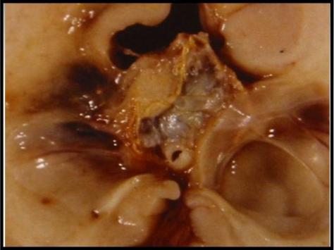 Neuropathology Set 2 Q5