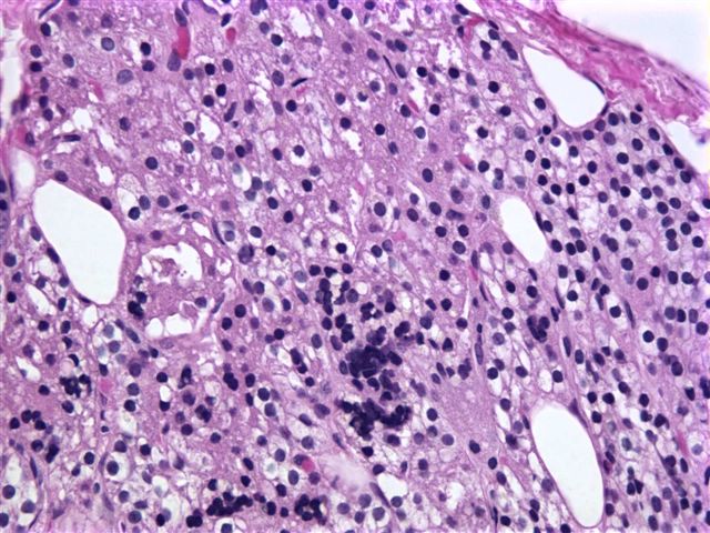 Invite a single chair, even one that differs from the rest of your décor, to serve as a distinctive—and functional—focal point to a room or corner. Pathology Outlines - Ectopic parathyroid tissue