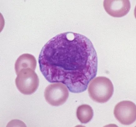 Faggot cell in acute promyelocytic leukemia