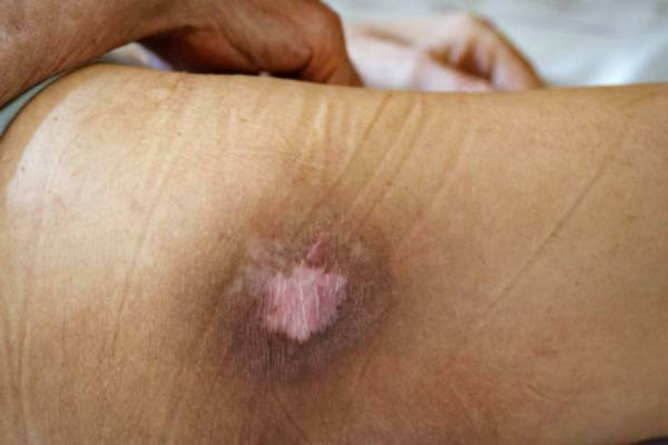 Leg skin ulceration