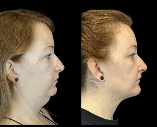 Facial liposuction in uae