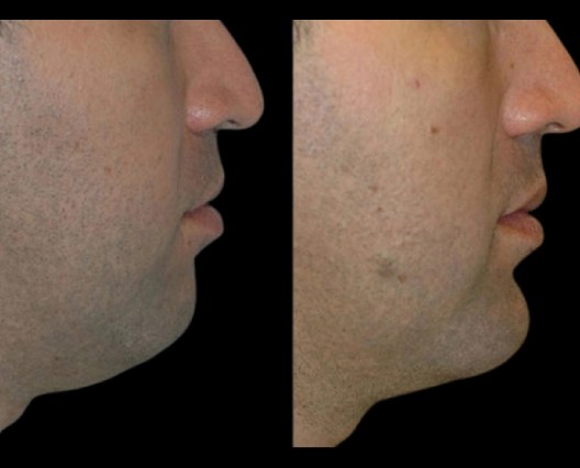 Chin-liposuction