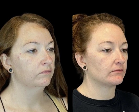 Facial liposuction in abu dhabi