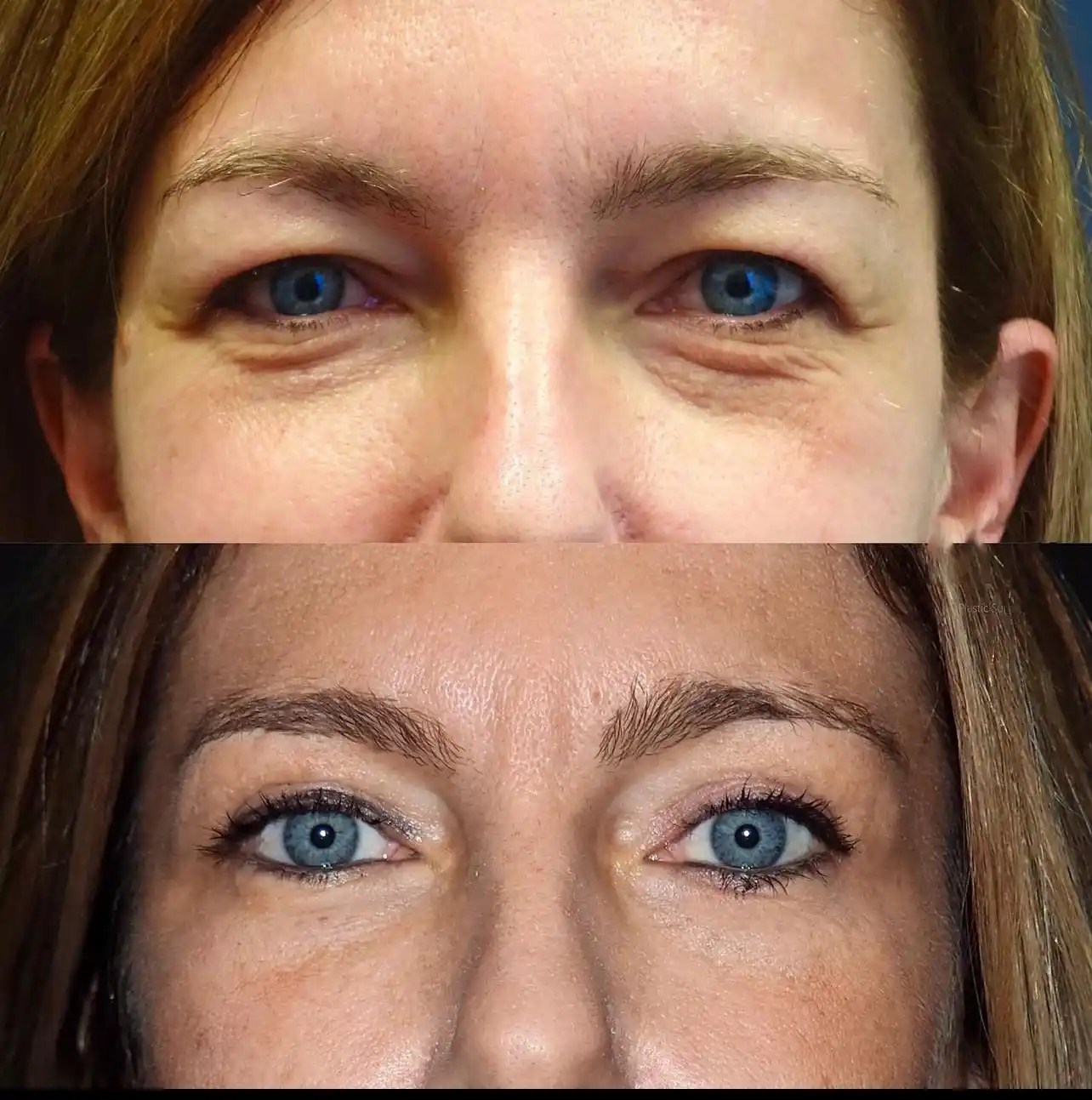 Blepharoplasty In Dubai Abu Dhabi - Eyelid Surgery In Dubai AED 6999+ Abu  Dhabi Best Surgeon