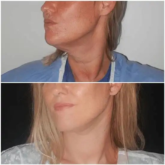 Vertical facelift vertical rhytidectomy cost in dubai