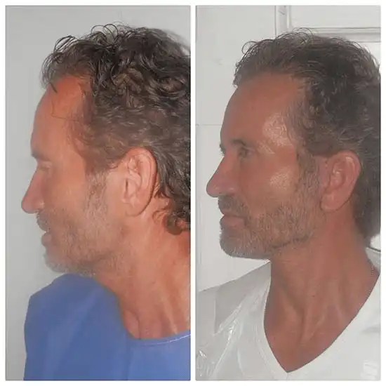 Mid facelift cheek lift cost in dubai