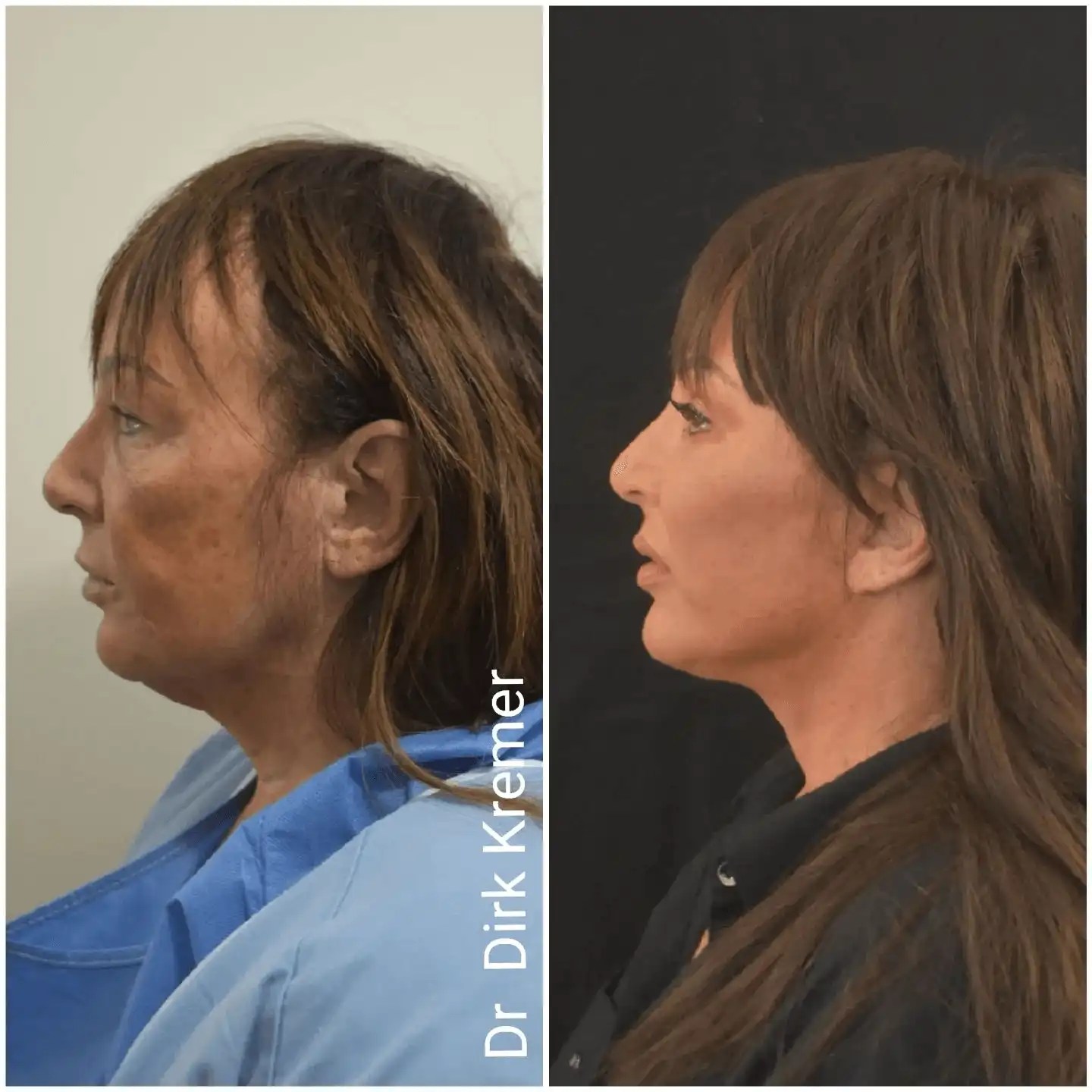 Vertical facelift vertical rhytidectomy cost in dubai