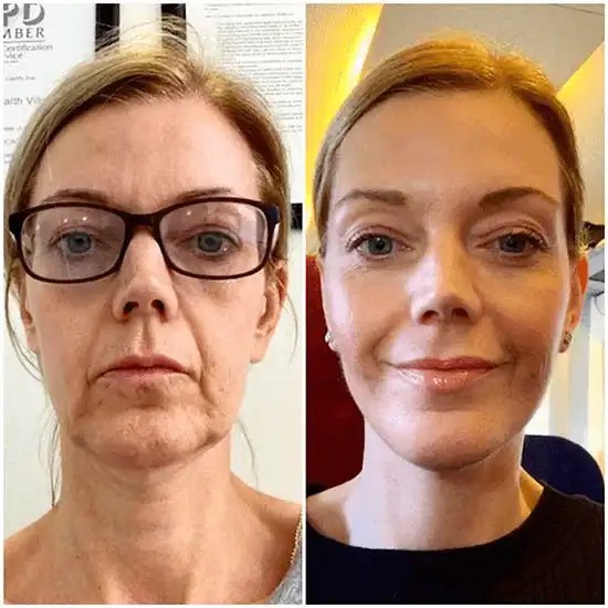 mid Facelift surgery in dubai