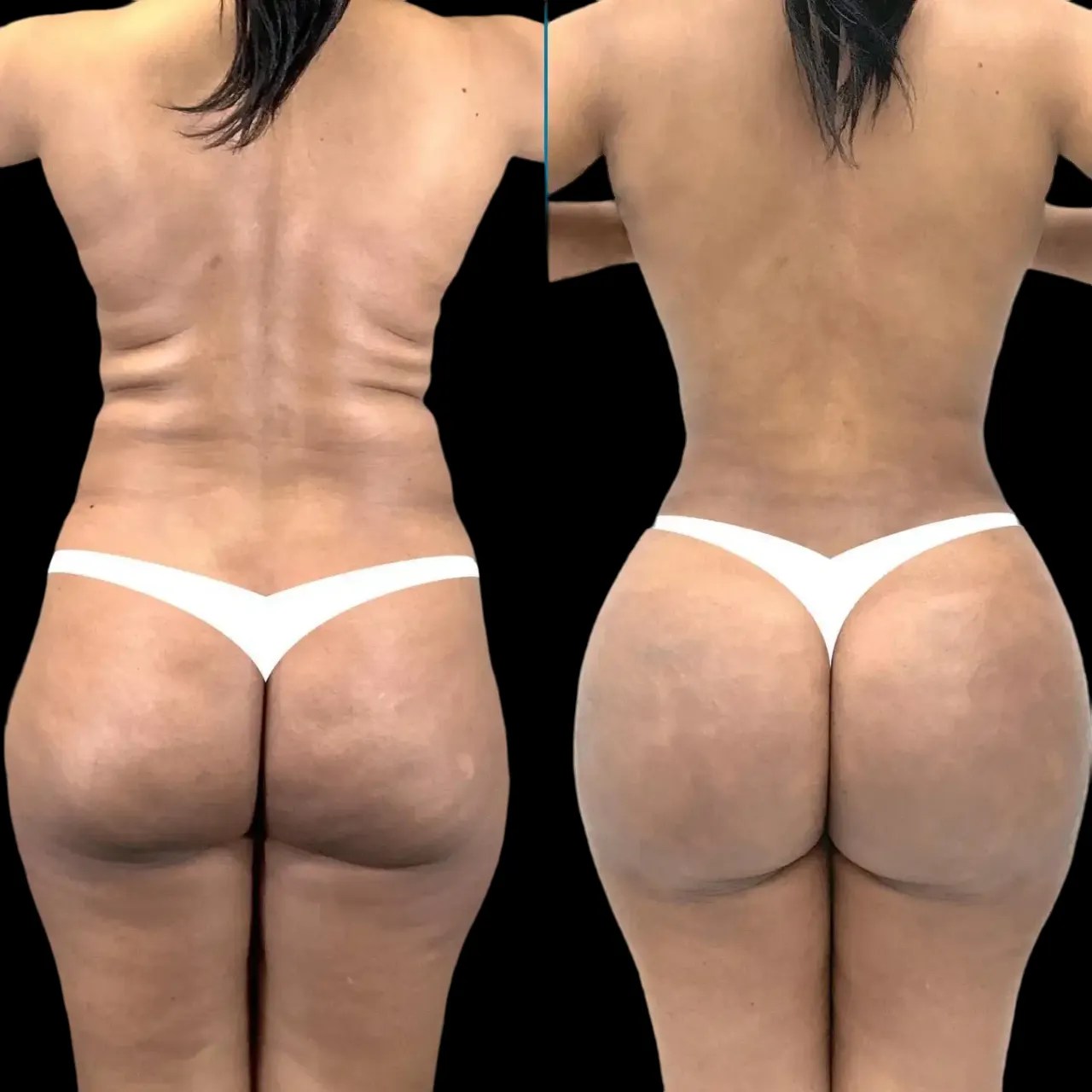 Buttock fat transfer in dubai