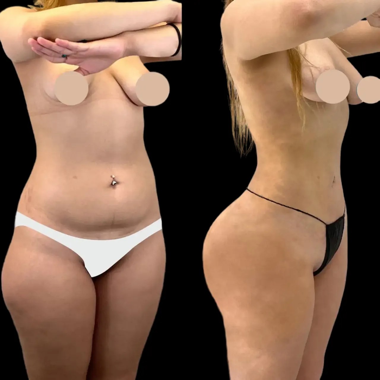 Buttock fat transfer before and after pictures in dubai uae