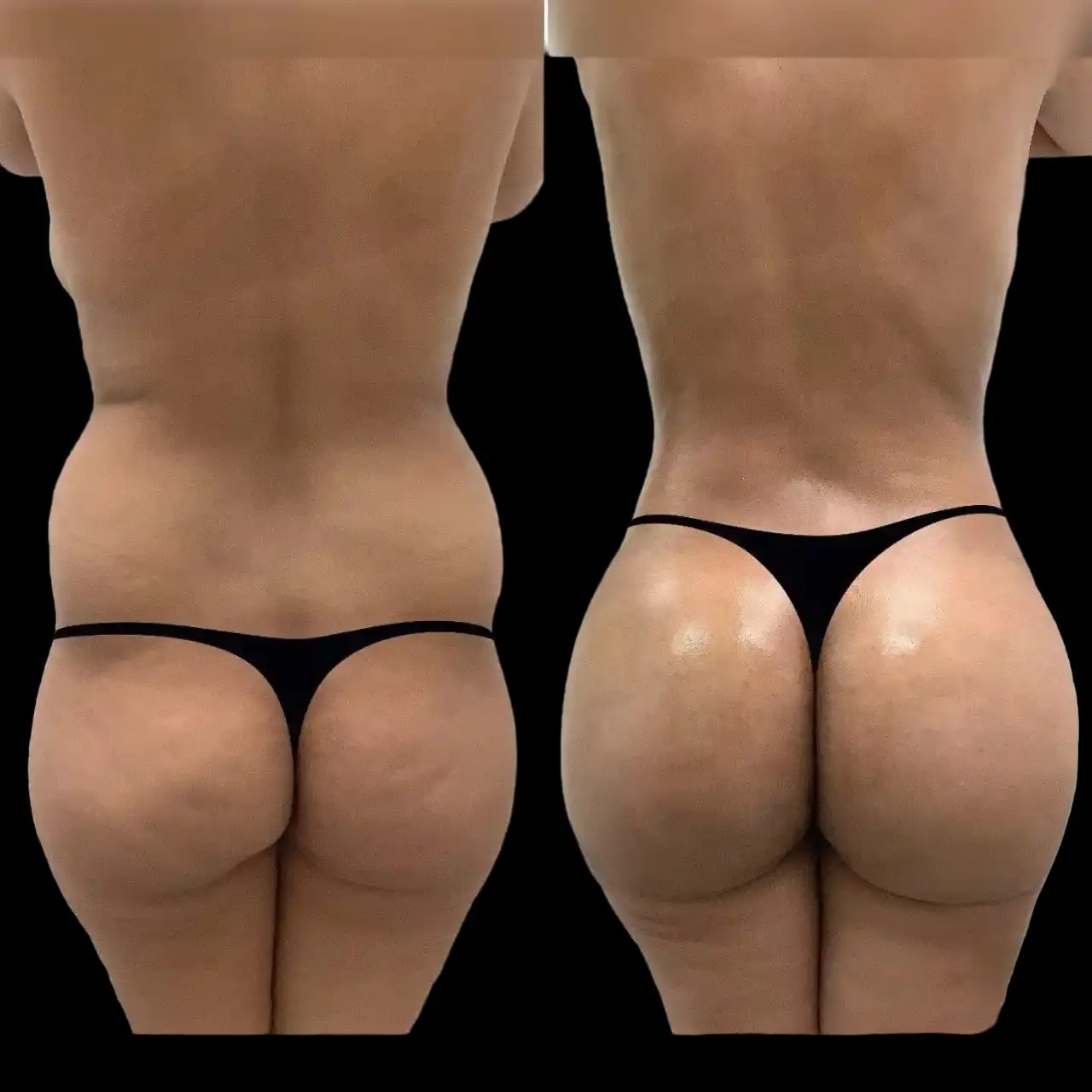 Buttock fat transfer in dubai