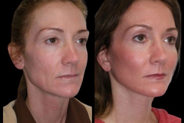 Cheek augmentation in dubai cheek augmentation