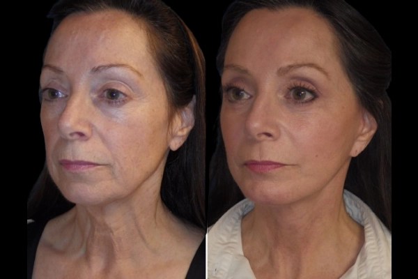 Cheek augmentation in uae cheek augmentation