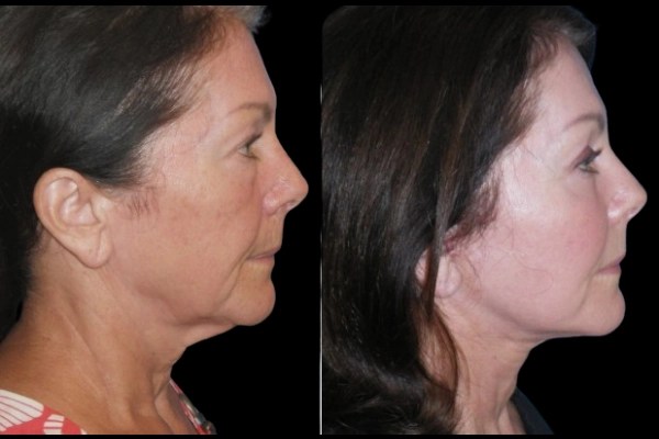 Facial fat transfer