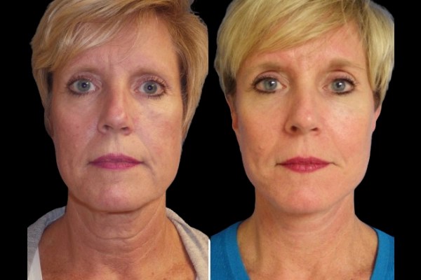 Facial fat transfer before and after images in uae