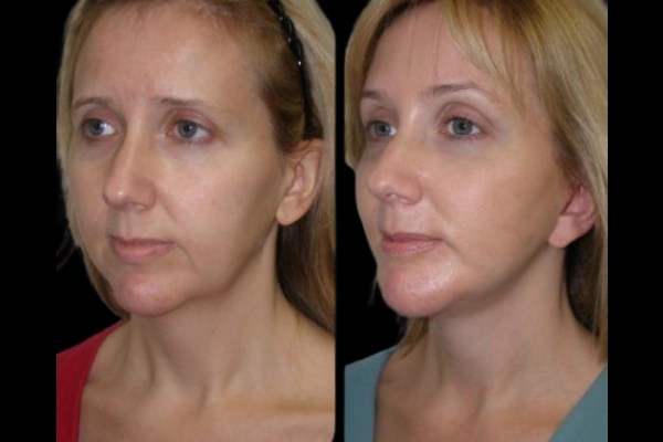 Cheek fat transfer