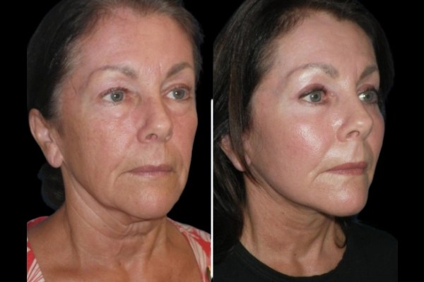 Facial fat transfer