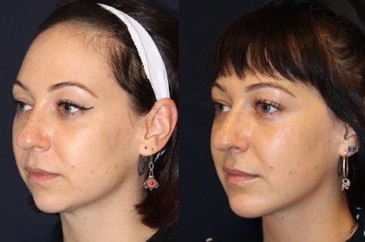 Chin implants