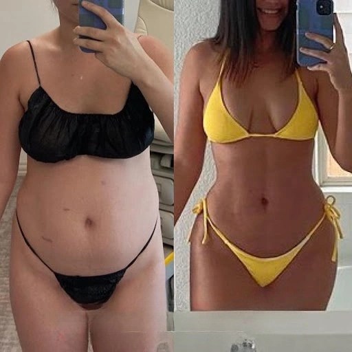 Liposuction in dubai before & after photo