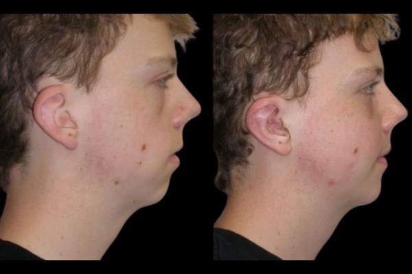 Male Cheek augmentation in Dubai